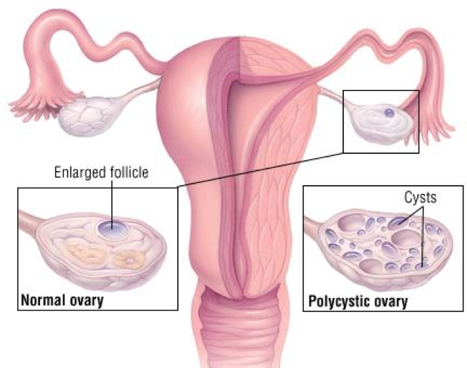 PCOS treatments in India